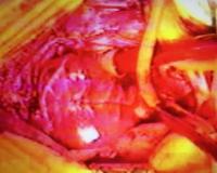 Imagen 3 del trasplante realizado por el doctor Javier Cabo  